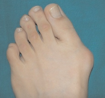 Alluce valgo, quali sono i sintomi per riconoscerlo e come si cura