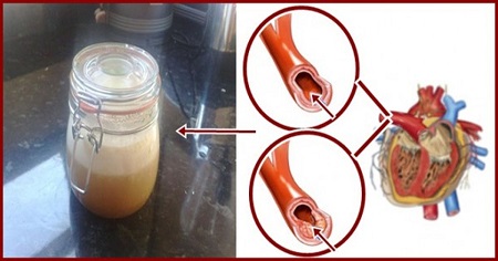 Colesterolo e pressione alta Colesterolo e pressione alta