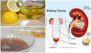 Come Eliminare Renella E Calcoli Dai Reni In 8 Giorni