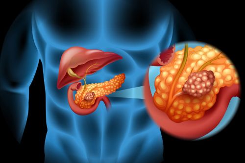 Tumore al pancreas, attenzione a questo strano sintomo improvviso: ecco di cosa si tratta