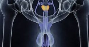 prostata tumore