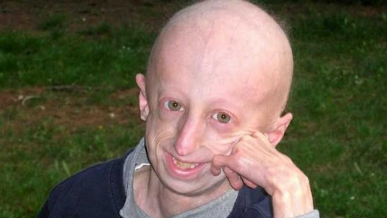 Progeria, cos’è? Sintomi e conseguenze della malattia dei “nati vecchi”