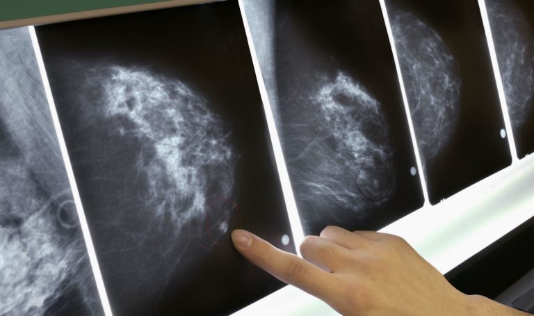 Tumori, ecco gli accorgimenti per ridurre il rischio di morire