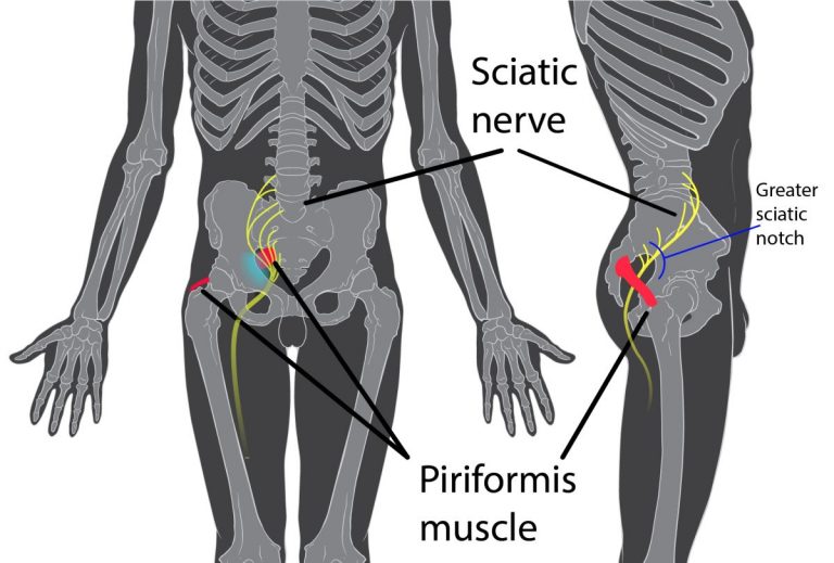 E’ la “bomba” contro la sciatica. Bastano due ingredienti per dire addio al dolore