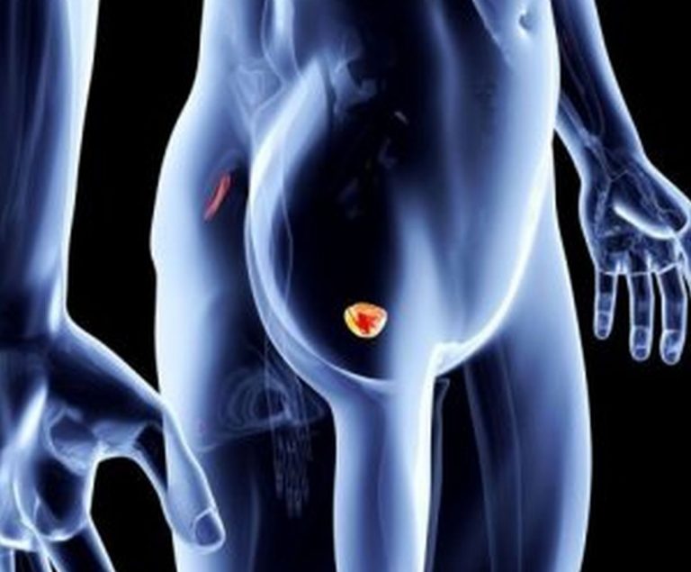 Tumore alla prostata: attenzione a questi sintomi, ecco come riconoscere la malattia