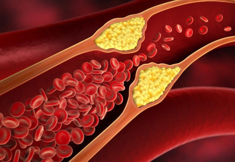 Questi 4 sintomi silenziosi stanno indicando che le arterie sono ostruite Questi 4 sintomi silenziosi stanno indicando che le arterie sono ostruite