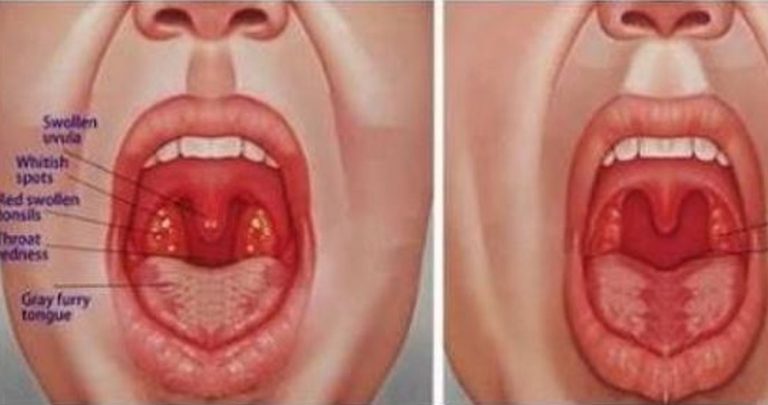 Eliminare subito le placche alla gola senza antibiotici: ecco il rimedio dell’anno Eliminare subito le placche alla gola senza antibiotici: ecco il rimedio dell’anno