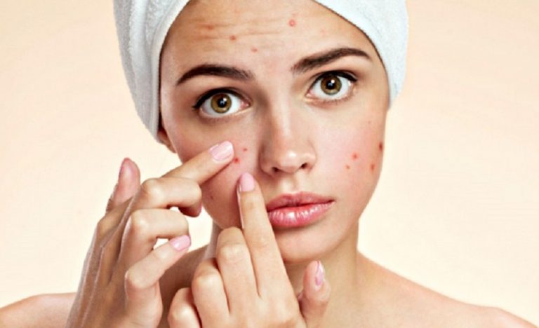 Acne, come combatterla e tenere a bada i brufoli