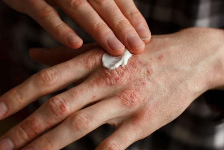 Psoriasi, ecco il nuovo farmaco per contrastarla Psoriasi, ecco il nuovo farmaco per contrastarla