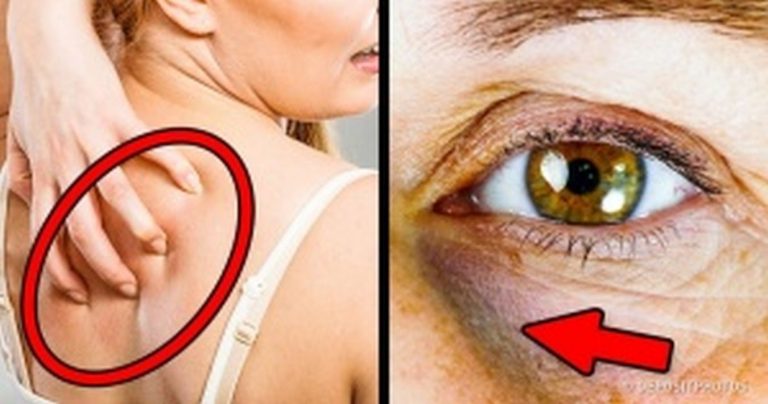 Tutti questi segnali stanno indicando un alto livello di zucchero nel sangue. Ecco quali Tutti questi segnali stanno indicando un alto livello di zucchero nel sangue. Ecco quali