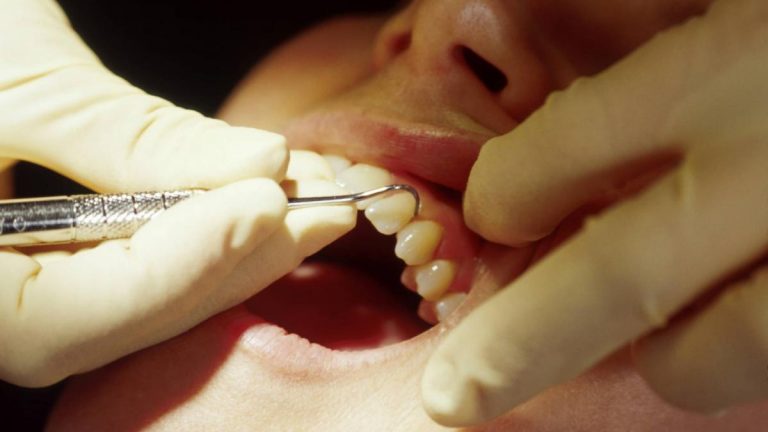 Le comuni infezioni orali aumentano il rischio di aterosclerosi in età adulta