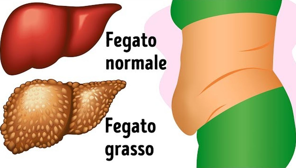 Fegato Grasso Se Stanno Comparendo Tutti Questi Segnali è