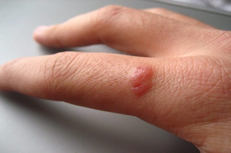 Soffri di papillomi o verruche? Ecco cosa devi fare urgentemente per eliminare il problema