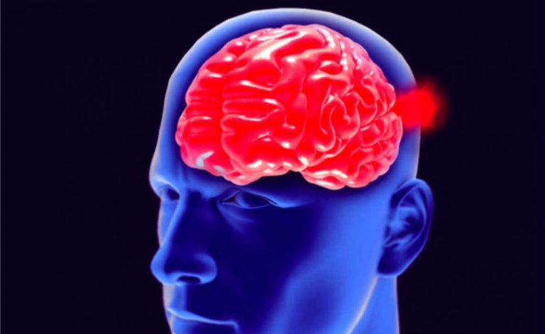 Aneurisma cerebrale, ecco quali sono i sintomi da non trascurare Aneurisma cerebrale, ecco quali sono i sintomi da non trascurare