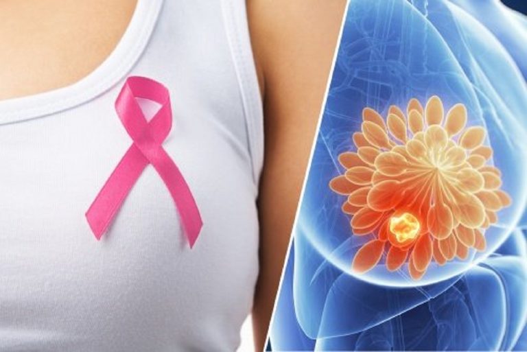 Tumore al seno, ecco i sintomi da riconoscere e non sottovalutare Tumore al seno, ecco i sintomi da riconoscere e non sottovalutare