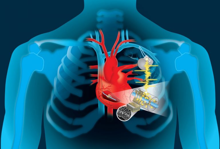 Pacemaker, testato il nuovo dispositivo che si ricarica da solo: come funziona