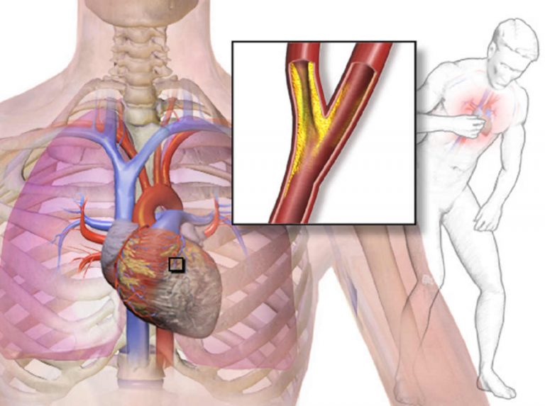 Angina pectoris, se stai avendo questi sintomi devi subito allarmarti