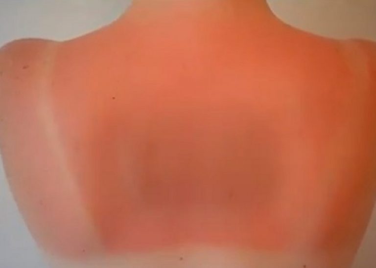 Ustioni, ecco i comportamenti da evitare e le cose da fare: il parere di un esperto