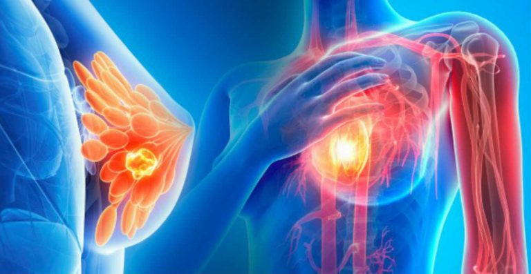 Tumore al seno, le mammografie del futuro analizzeranno la densità: perchè si tratta di una svolta Tumore al seno, le mammografie del futuro analizzeranno la densità: perchè si tratta di una svolta