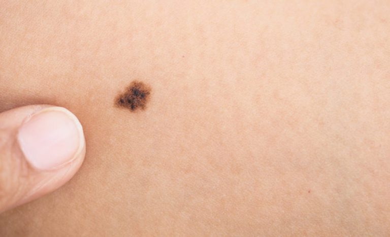 Come riconoscere un melanoma? Tutti i consigli per prevenirlo Come riconoscere un melanoma? Tutti i consigli per prevenirlo