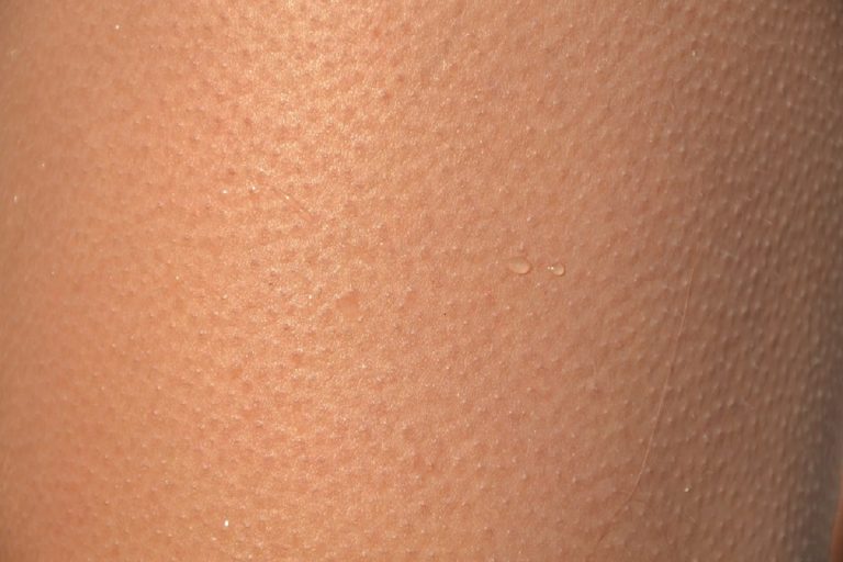 Attenzione alle macchie sulla pelle d’estate: scopri subito le cause e come riconoscerle