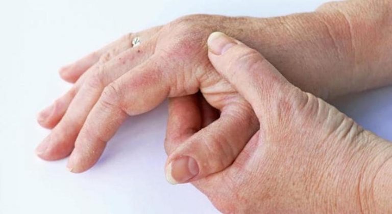 Artrite, psoriasi e morbo di Crohn: ecco la relazione tra queste tre patologie Artrite, psoriasi e morbo di Crohn: ecco la relazione tra queste tre patologie