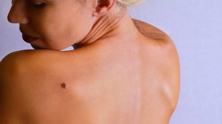 Melanoma, ecco il test su una proteina che controlla la mutazione dei tumori Melanoma, ecco il test su una proteina che controlla la mutazione dei tumori