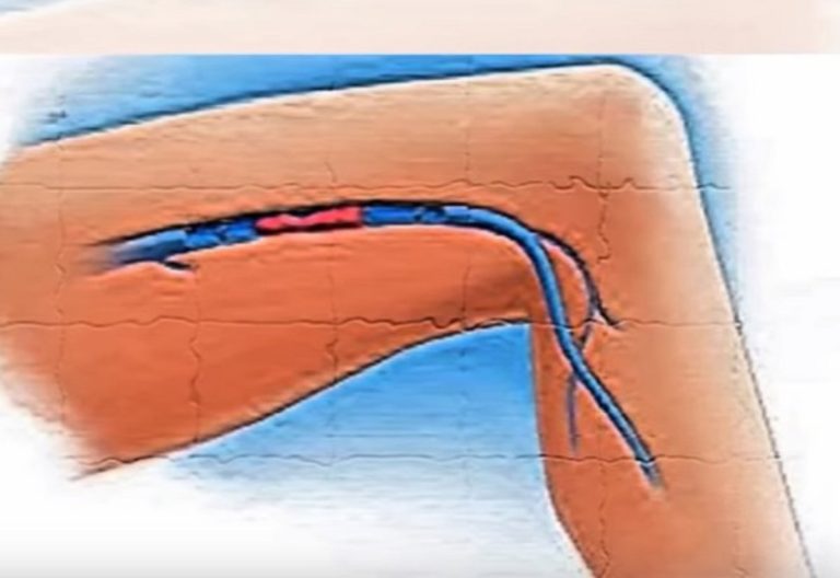 Pesantezza e formicolio nelle gambe ? Potresti soffrire di questo disturbo che mette a rischio il cuore
