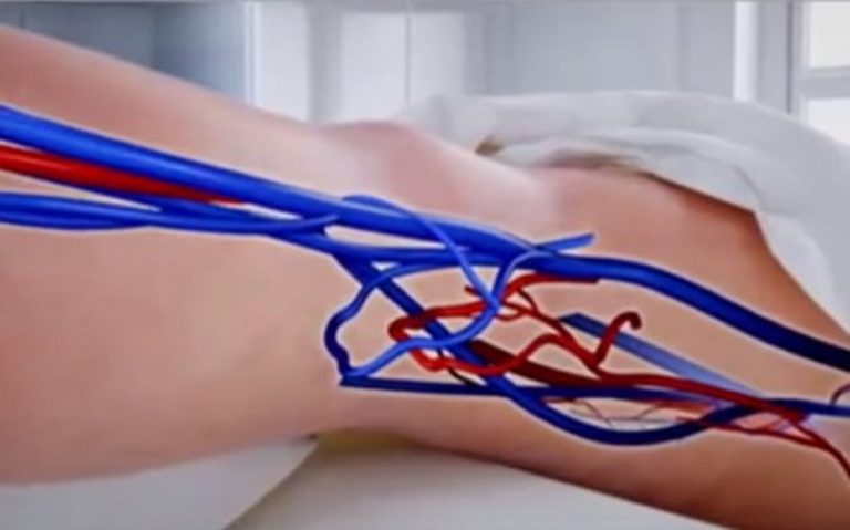 Se noti coaguli di sangue alle gambe consulta subito il medico: i rischi che potresti correre Se noti coaguli di sangue alle gambe consulta subito il medico: i rischi che potresti correre