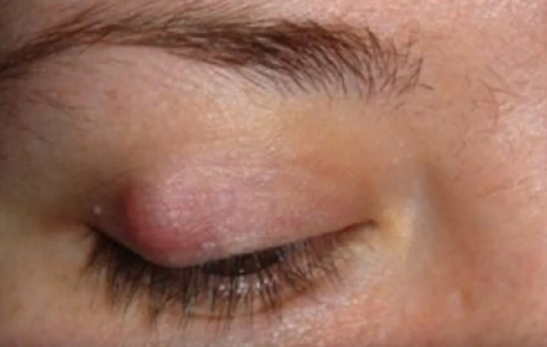 Diagnosticata una rara infezione agli occhi causata da batteri carnivori