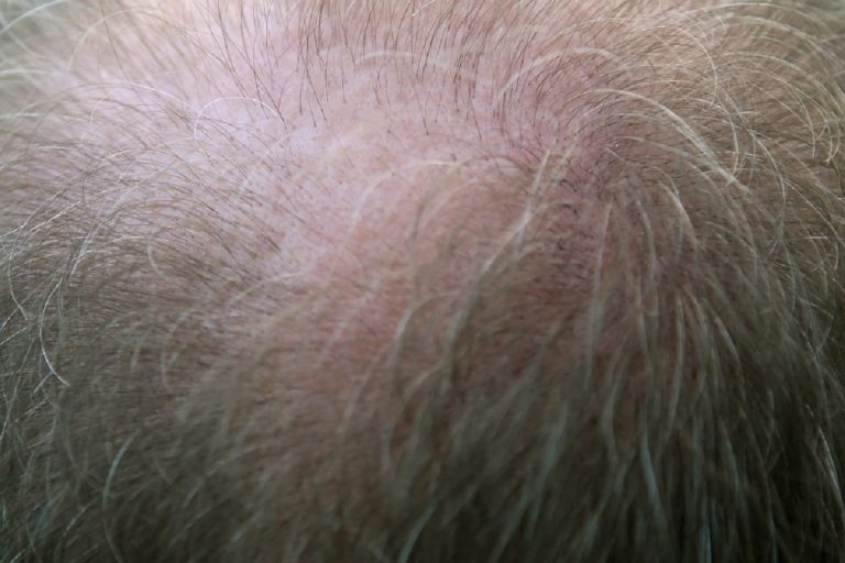 Caduta dei capelli e problemi alla tiroide: ecco i sintomi che devono preoccuparci Caduta dei capelli e problemi alla tiroide: ecco i sintomi che devono preoccuparci