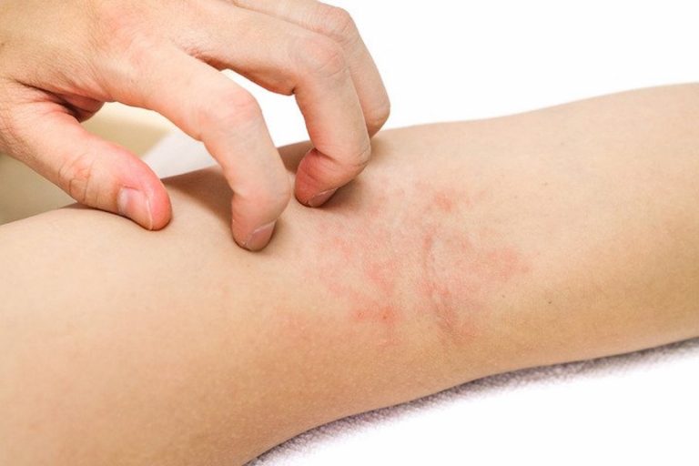 Psoriasi, pazienti scontenti dalle cure tradizionali: ecco i rimedi alternativi Psoriasi, pazienti scontenti dalle cure tradizionali: ecco i rimedi alternativi