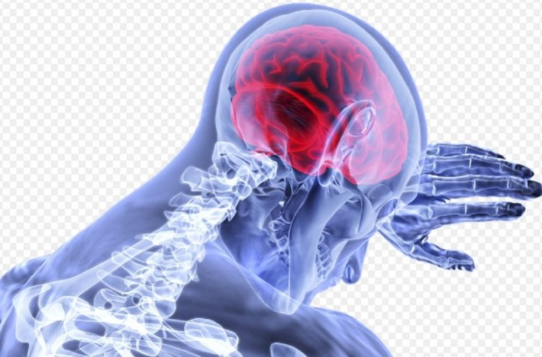 Se Avverti Questi Sintomi Potresti Avere Un Attacco Ischemico Transitorio Tia