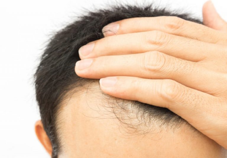 Perdita di capelli e carenza di ferro, esiste davvero una correlazione ?