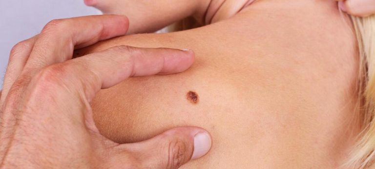 Melanoma, ecco come prevenirlo in tre mosse secondo il dermatologo Pellacani: ”La crema solare…”