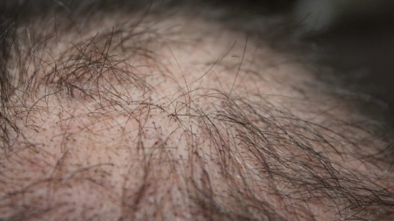 Long Covid, la perdita dei capelli dopo la malattia può colpire una persona su cinque