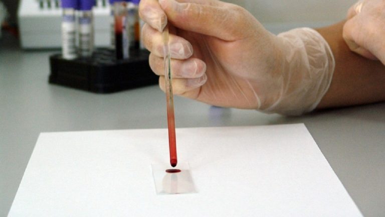 Un test sperimentato negli Usa è in grado di rilevare la presenza di 50 tumori nel sangue