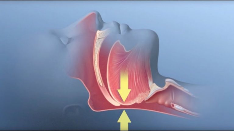 Apnea notturna ostruttiva, arriva il nuovo farmaco che potrebbe risolvere il problema definitivamente Apnea notturna ostruttiva, arriva il nuovo farmaco che potrebbe risolvere il problema definitivamente
