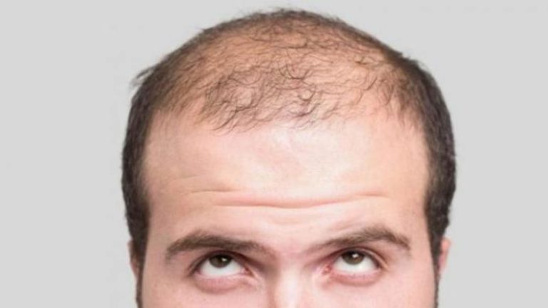 Perché invecchiando cadono i capelli? Ecco la risposta