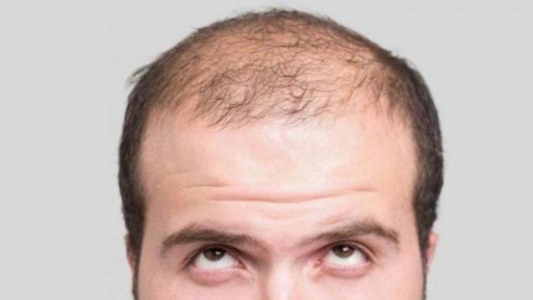 Perché invecchiando cadono i capelli? Ecco la risposta Perché invecchiando cadono i capelli? Ecco la risposta