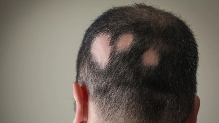 Caduta dei capelli, stop all’alopecia: ecco il farmaco anti calvizie, qual è e come funziona