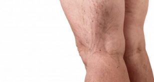 Vene varicose