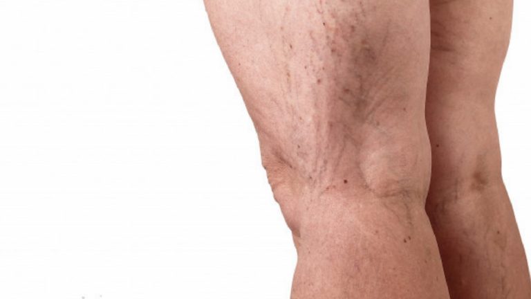 Vene varicose, ecco quando possono mettere a rischio la nostra salute Vene varicose, ecco quando possono mettere a rischio la nostra salute