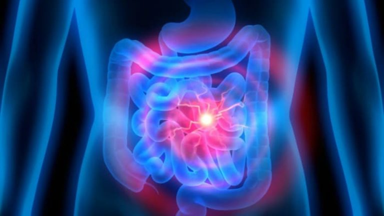 Infarto intestinale, ecco come riconoscerlo in tempo: i sintomi ai quali prestare attenzione Infarto intestinale, ecco come riconoscerlo in tempo: i sintomi ai quali prestare attenzione