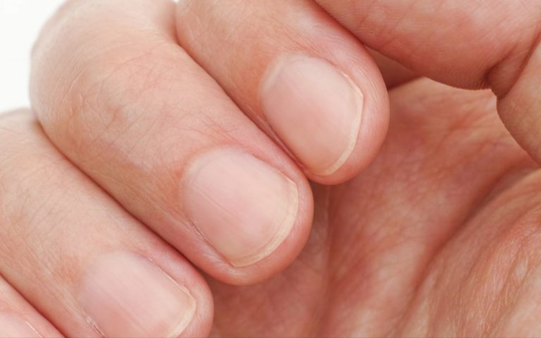 Le unghie rigate possono indicare diversi problemi di salute: ecco come riconoscerli Le unghie rigate possono indicare diversi problemi di salute: ecco come riconoscerli