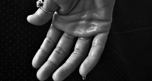 mani sudate iperidrosi