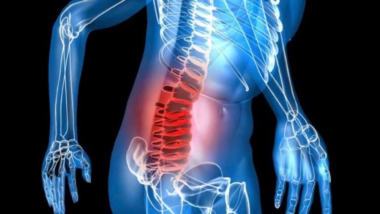 Metastasi alle vertebre, attenzione a questi sintomi che non vanno sottovalutati