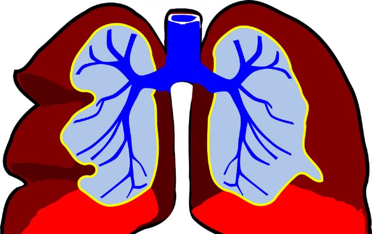 Tumore ai polmoni, attenzione a questo strano sintomo: potrebbe essere un campanello d’allarme
