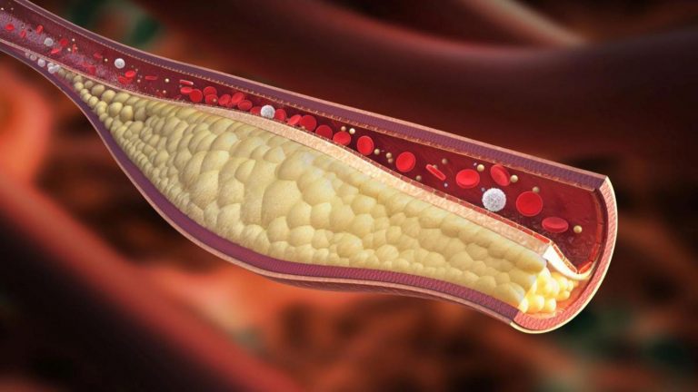 Colesterolo alto, questi sintomi possono indicare l’inizio di una malattia