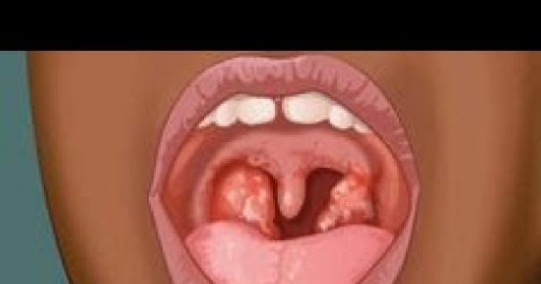 Mal di gola virale o batterico? Ecco come riconoscerlo dai sintomi e cosa fare per curarlo